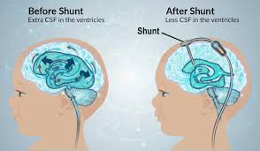 Shunt Surgery